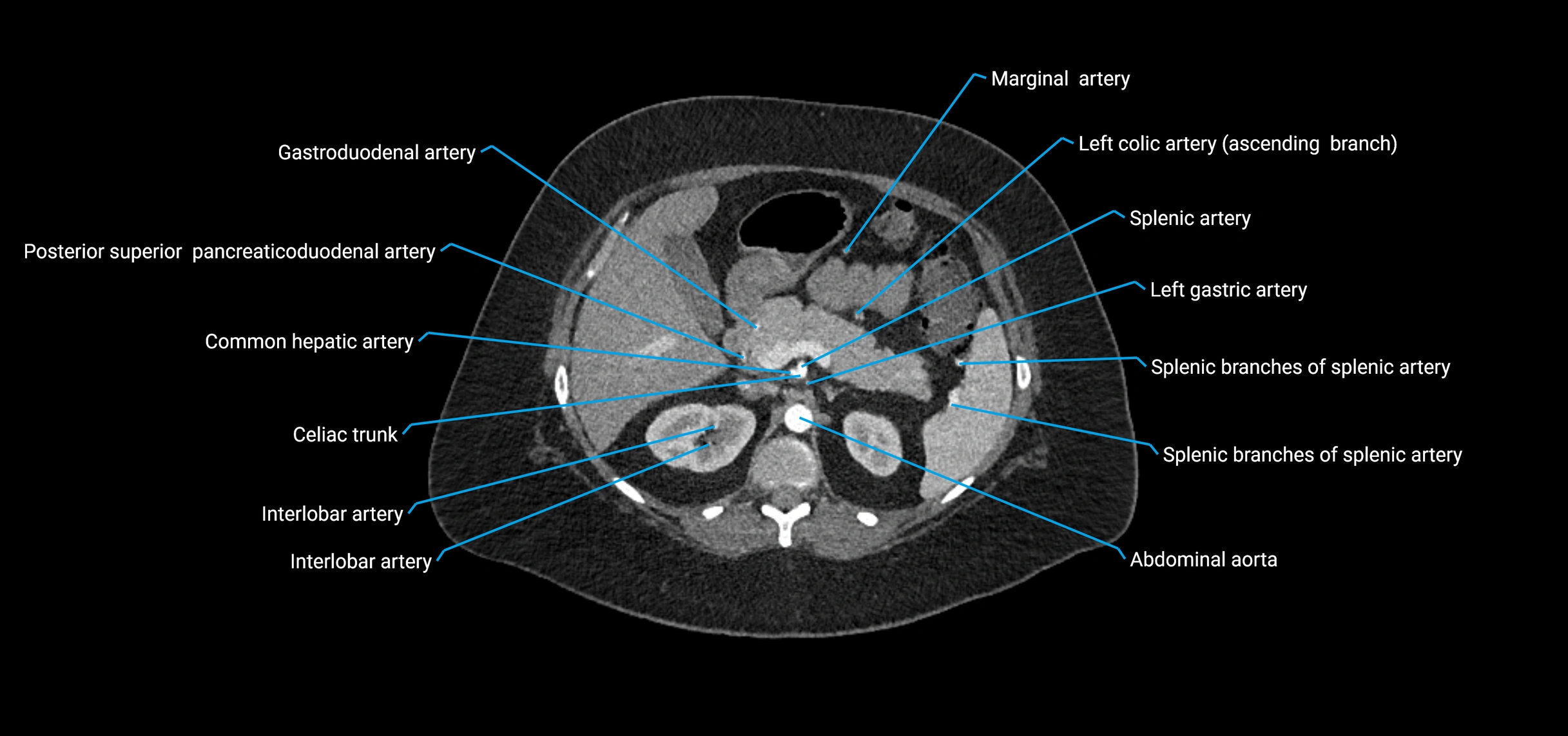 CTA abdomen axial cross sectional anatomy labelled image_54 (2).webp
